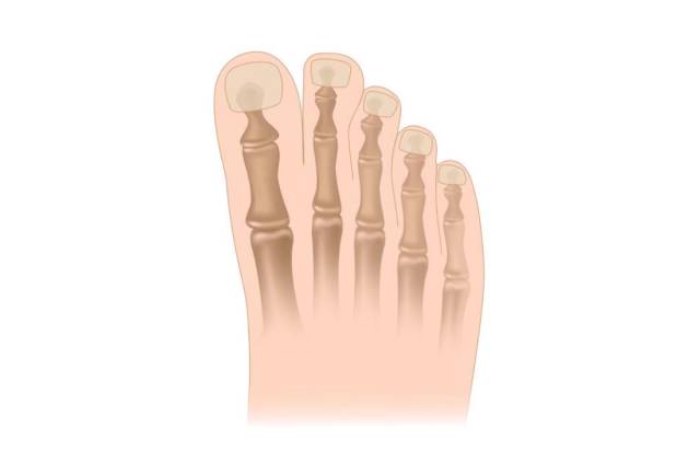 找到原因改变原因,脚磨的泡是怎么形成的