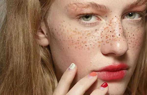 来看看斑点是怎么形成的,16种斑如何分析鉴别