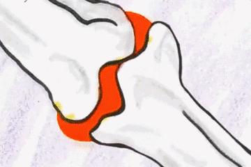 经常掰手指关节导致关节粗怎么办,老是想掰响指关节怎么办