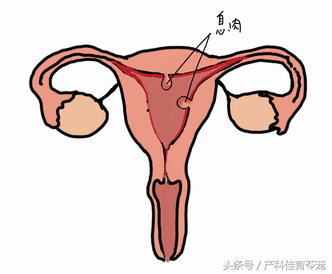 子宫腔长了息肉，哪些情况需要手术