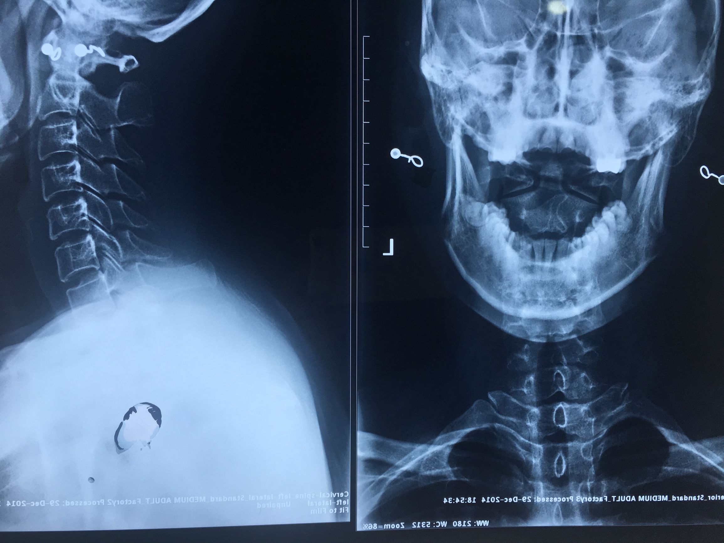 颈椎病为什么不能推拿,脊椎病是不是就治不好