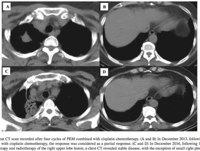 alk阳性肺癌克唑替尼,肺腺癌met基因突变克唑替尼耐药