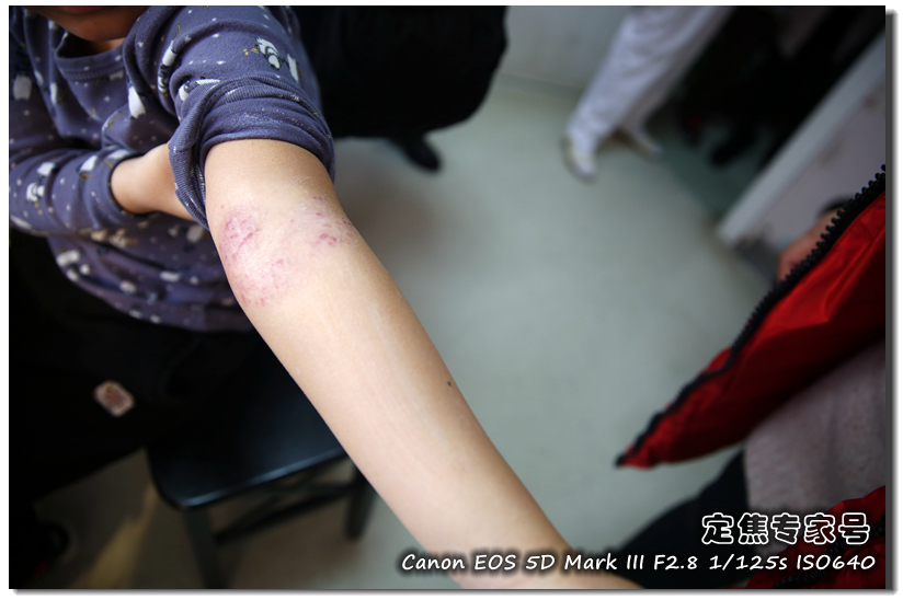 头皮一块一块的红斑,头皮癣治疗要多少钱