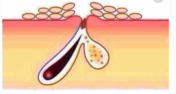 教你改善痘痘的3种方法,痘痘怎么消除小妙招不花钱