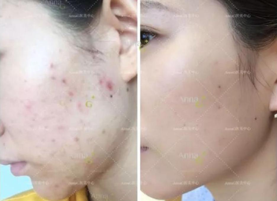 急救熬夜长痘精华,教你6招解决熬夜肌肤问题