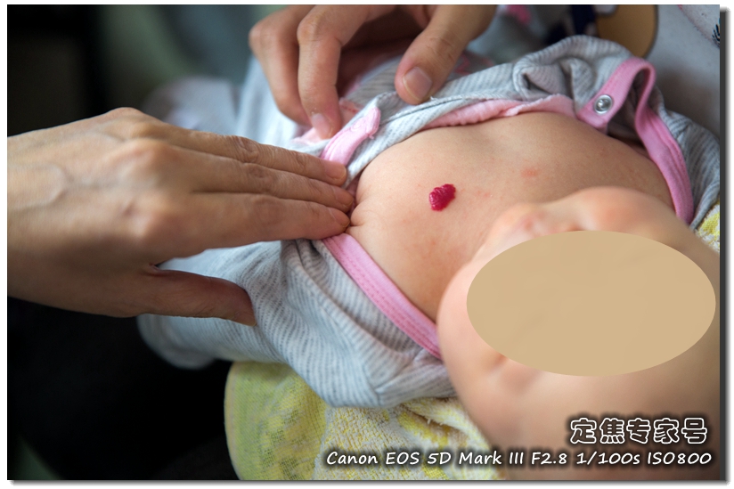 头皮癣治疗要多少钱,治疗头皮型银屑病需要多少钱