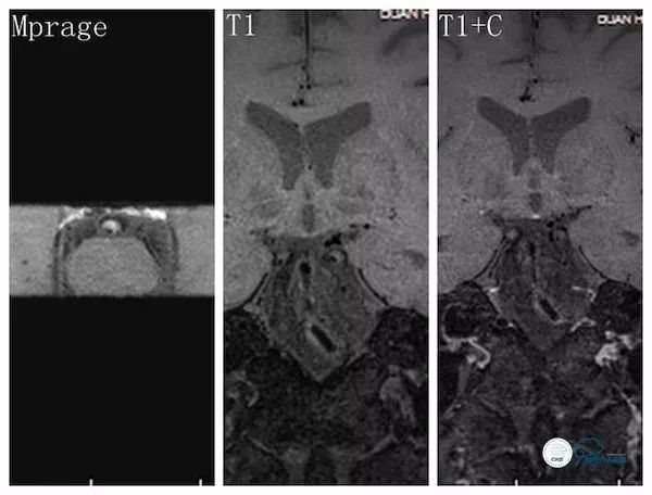 天坛医院脑血管狭窄手术做得好吗,天坛医院动脉狭窄介入手术费用