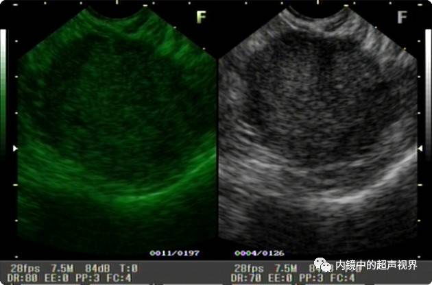 超声内镜美图攻略——动态范围与伪彩