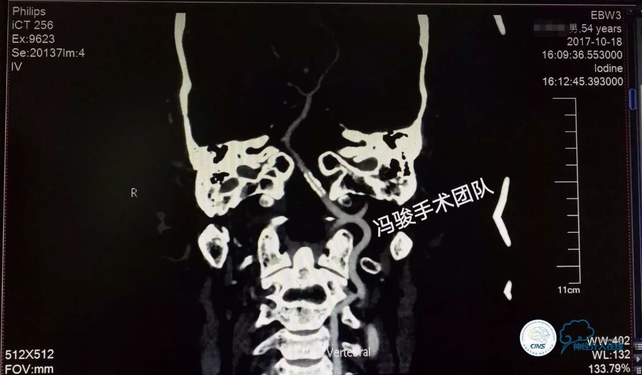 天新福—百家百言｜一例孤独椎动脉V4段并PICA重度狭窄支架手术及1年随访