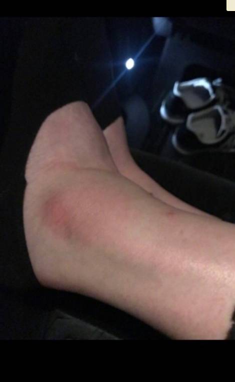 奚梦瑶摔倒后腿如何了,奚梦瑶受伤片段