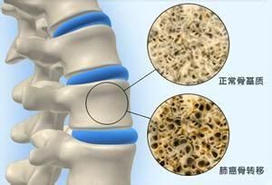 肺癌转移到骨头的病人后期会怎样,肺癌会影响面部神经吗
