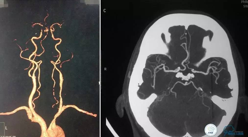 急性缺血性卒中静脉溶栓2018指南,急性缺血性卒中血管内再通标准