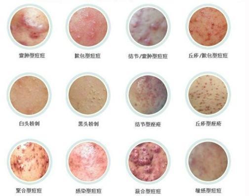 关于痘痘的解答,一篇文章终结你关于痘痘的疑问