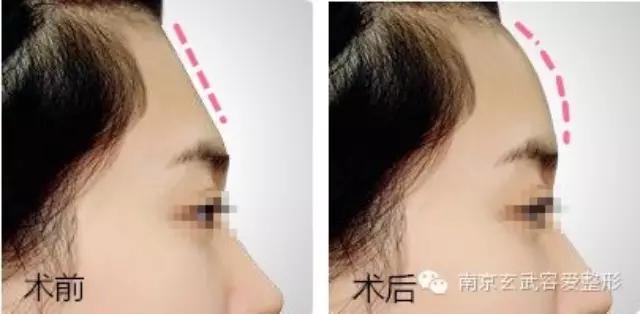 自体脂肪丰额头恢复期图,自体脂肪丰额头第一天图片