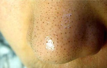 去黑头鼻贴为什么能让黑头浮出,去黑头药膏可以彻底清除黑头吗