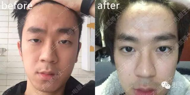 抬头纹手术会不会影响眼睛,抬头纹手术后有后遗症吗