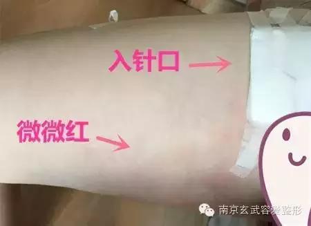 自体脂肪丰额头恢复期图,自体脂肪丰额头第一天图片