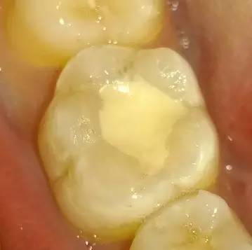 牙齿有矿物质怎么处理,牙齿有洞用什么充填