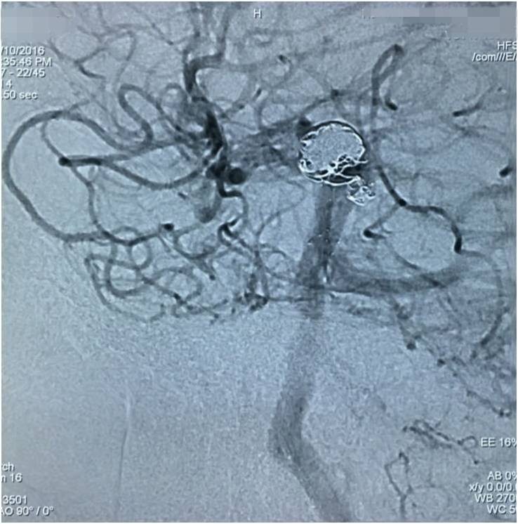 基底动脉顶端动脉瘤加左侧小脑上动脉瘤以Y型支架结合弹簧圈栓塞