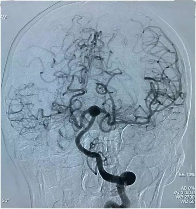 基底动脉顶端动脉瘤加左侧小脑上动脉瘤以Y型支架结合弹簧圈栓塞