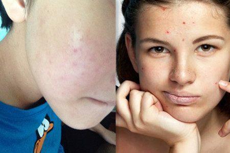 红霉素祛痘印效果好吗,红霉素祛痘印的正确方法