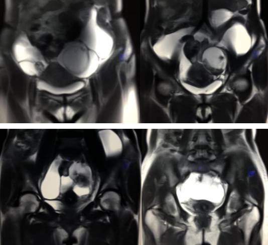 中下腹胀痛见于哪些疾病,女性下腹坠痛是不是有炎症