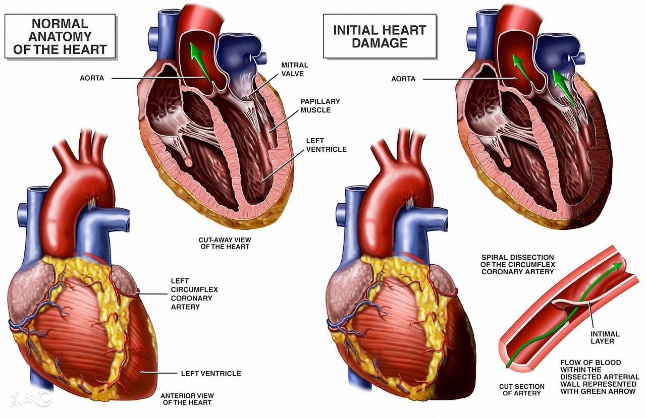 冠心病秋冬防治,冬季冠心病预防措施