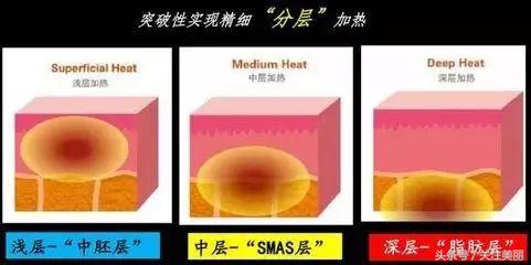 为什么热拉提这么便宜,热拉提多久做一次效果好