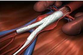 腹主动脉瘤的中医诊断,腹主动脉瘤手术费用是多少