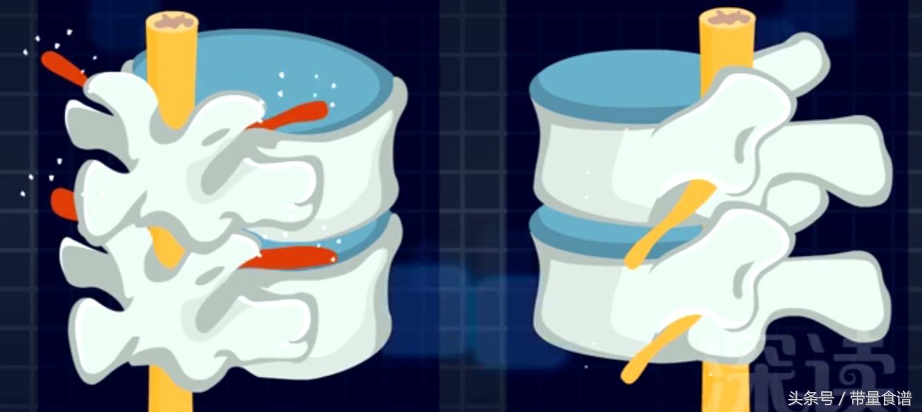 坐不久就腰痛怎么回事,坐着的时候腰椎间盘突出