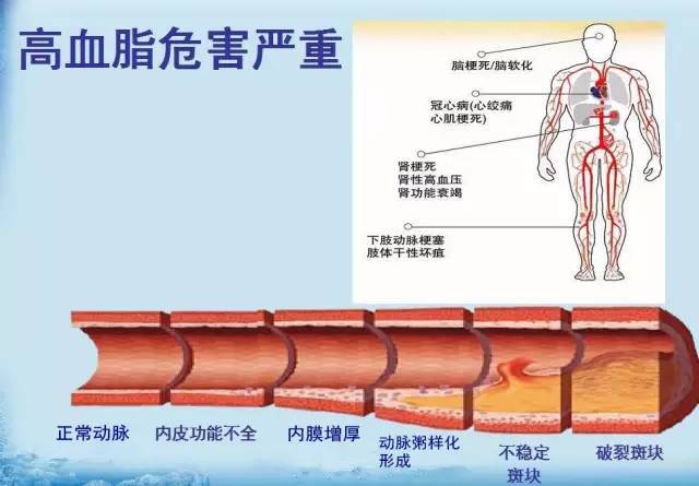 高血脂你真的了解吗,高血脂医学上叫什么