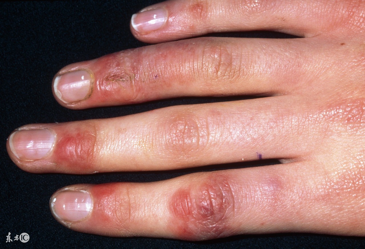 冻疮怎么防治小妙招,防治冻疮的最好方法