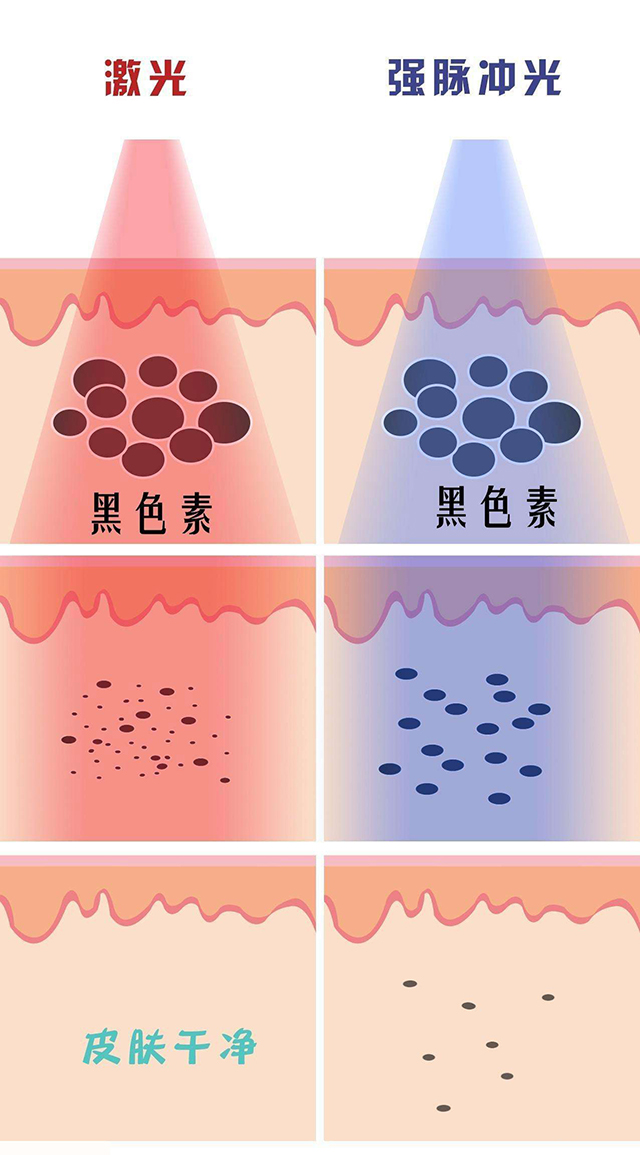点的雀斑留色素了怎么办,表皮雀斑怎么去除