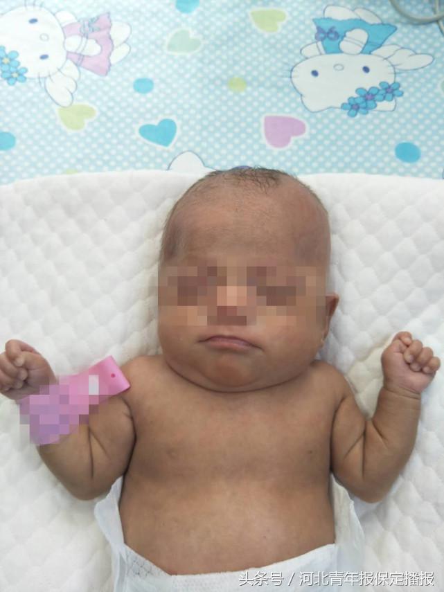 保定新生婴儿出生,生长受限的早产儿刚出生的照片