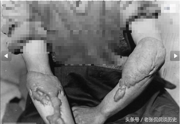 在广岛被核辐射的人长什么样,广岛核辐射照片