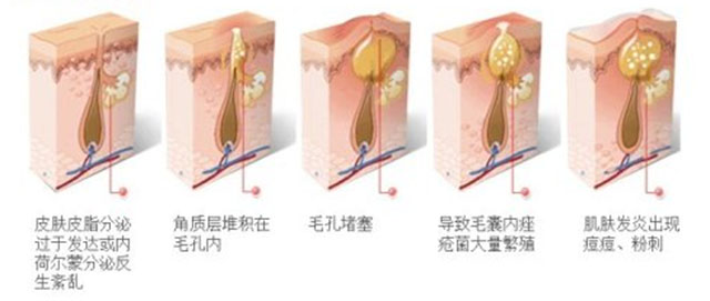 青春痘有什么方法解决,青春期已经长痘了怎么改善皮肤