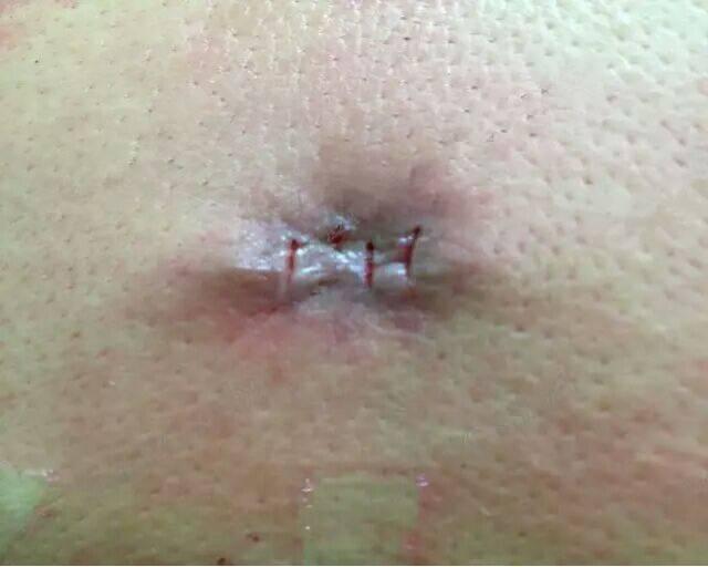 像小瘤一样的痣是什么,有个像疤一样的痣