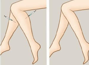 瘦腿针有没有效果有什么副作用,小腿太粗打瘦腿针有副作用吗