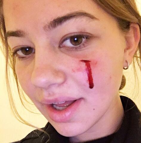 现在打架斗殴怎么解决,打架脸肿起来大包怎么办