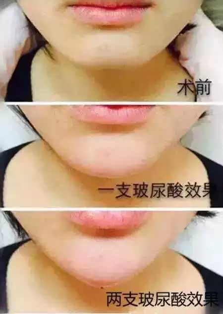 丰下巴用玻尿酸好还是自体脂肪好,玻尿酸丰下巴后要注意哪些问题
