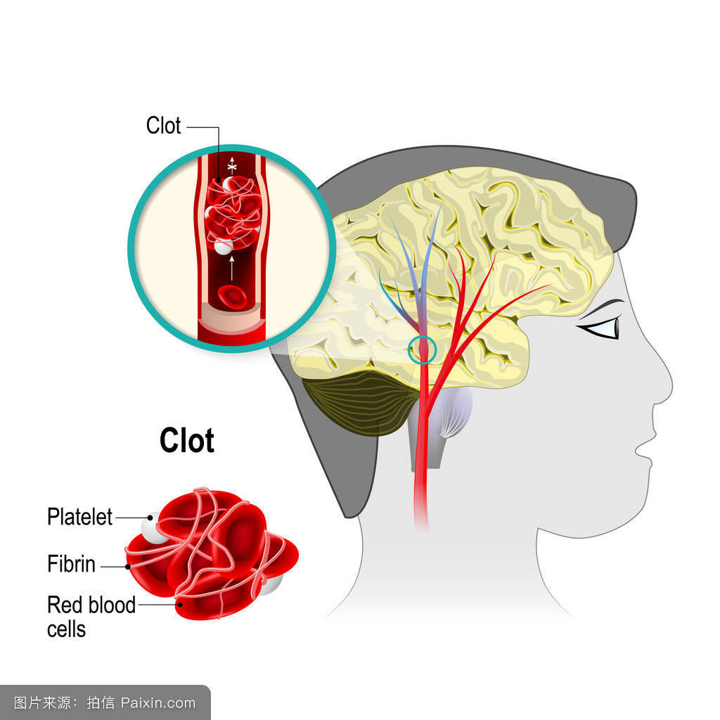 老人脑梗塞怎样急救动画演示,脑梗塞病人的急救护理ppt