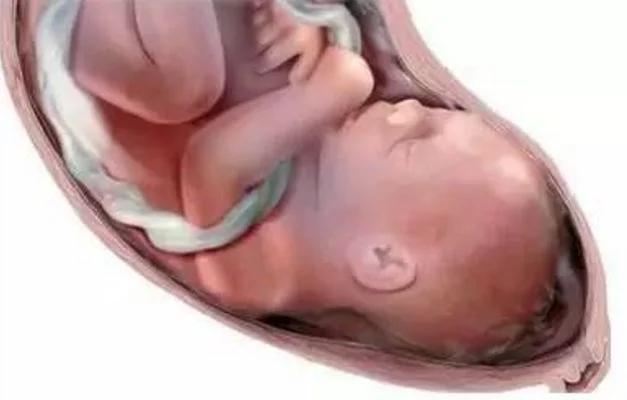 脐带绕颈两周顺产还是剖腹产安全,32周脐带绕颈两周头位