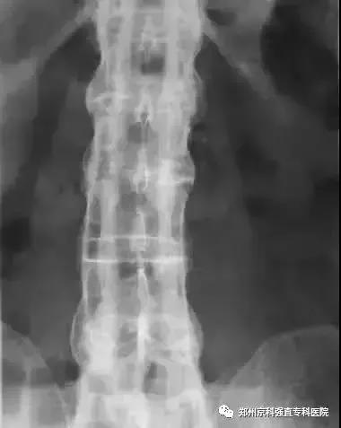 强直性脊柱炎需要做什么检查确诊,强直性脊柱炎要做什么检查确诊