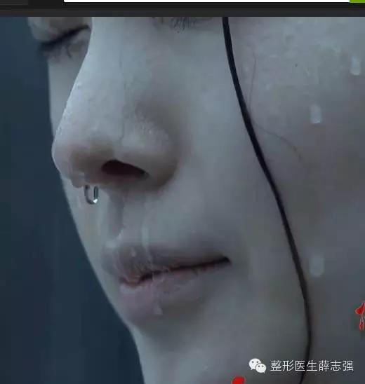 科普｜隆鼻假体，你知道不知道的那些事儿——扒一扒硅胶和膨体