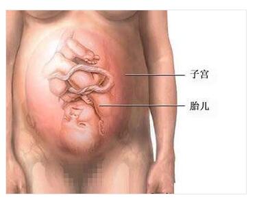 剖腹产全过程,剖腹产20天伤口真实照片