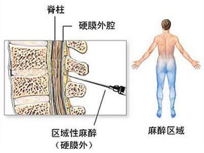 对于选择剖腹产的孕妈妈而言,到底剖腹产是怎样的?(图解)