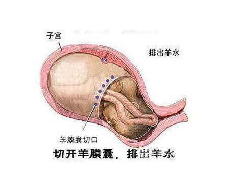 经历了剖腹产才知道妈妈的不容易,看了剖腹产才明白妈妈是多么伟大