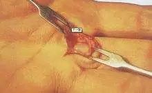 手腕血管周围有肿块是怎么回事,手腕上有突出的肿块能按摩下去吗