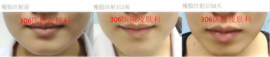 国家认可瘦脸针,军医扎针