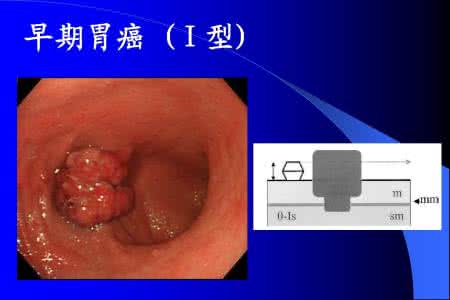 吃青菜肚子疼查出胃癌,一饿就胃疼查出胃癌